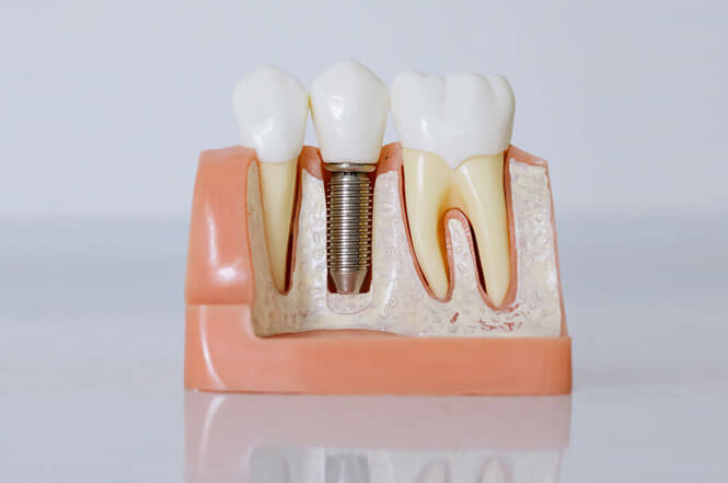 5 Signs You Need Emergency Dental Implants