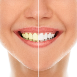 Are You Qualified for Teeth Whitening?