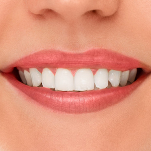 Best Professional Teeth Whitening Solutions | Sacramento 