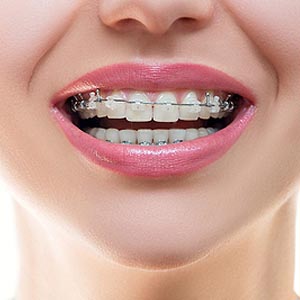 Can I Do Teeth Whitening While Wearing Braces? | Sacramento