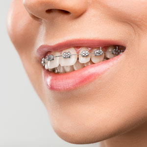 Dental Braces: What To Expect?