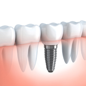 Dental Implants Sacramento California