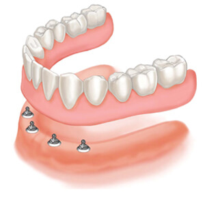 Dentures sacramento california