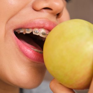 Eating Habits and Diet While Wearing Braces in Sacramento