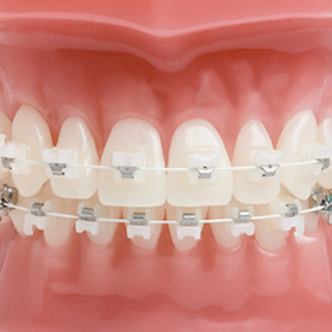 Gleaming Smiles: Clear Braces in Sacramento