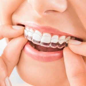 How Clear Braces Works to Straighten Teeth? | Sacramento, CA