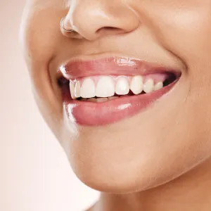 How Long Does Teeth Whitening in Sacramento Take?