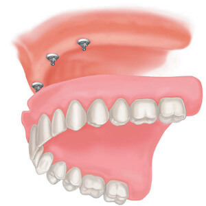 Dentures Sacramento california