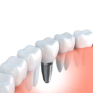Dental Implants Sacramento