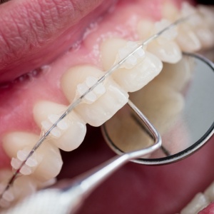 Treatment Time and Expectations of Clear Braces in Sacramento