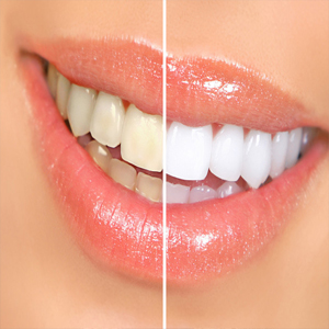 What Is Professional Teeth Whitening? | Sacramento, CA