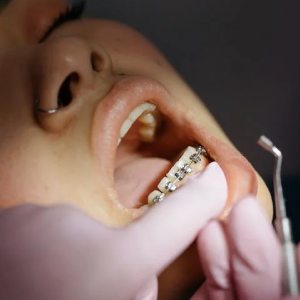 Are Your Braces Causing Discomfort? Here Are Quick Recourses
