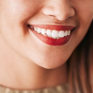 What to Expect During Teeth Whitening in Sacramento