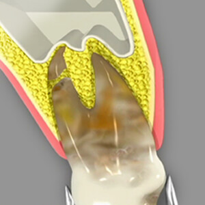 Tooth Extraction Sacramento California