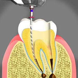 Non Surgical Root Canal Sacramento California