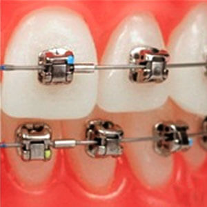 Dental Braces Sacramento CA