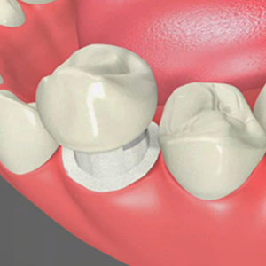 Dental Crowns Sacramento CA