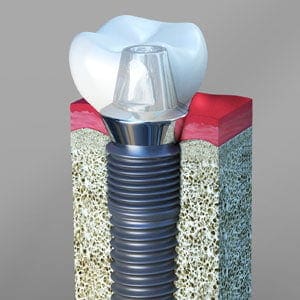 Dental Implants Sacramento California