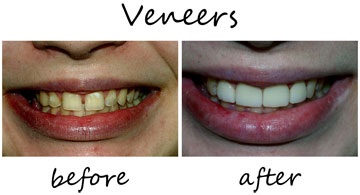 Veneers 1