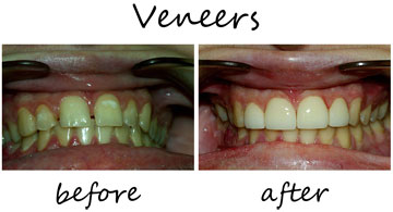 Veneers 3